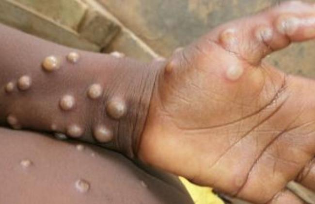 Belgium becomes first country to make quarantine compulsory for monkeypox patients