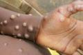 Belgium becomes first country to make quarantine compulsory for monkeypox patients